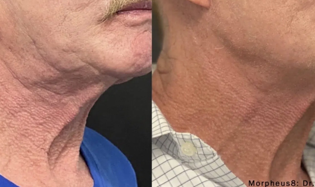 Supplied Morpheus8 before-and-after comparison showing neck and lower-face appearance