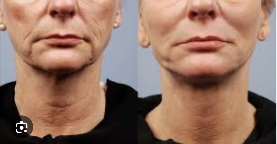 Supplied before-and-after comparison of the lower face and neck