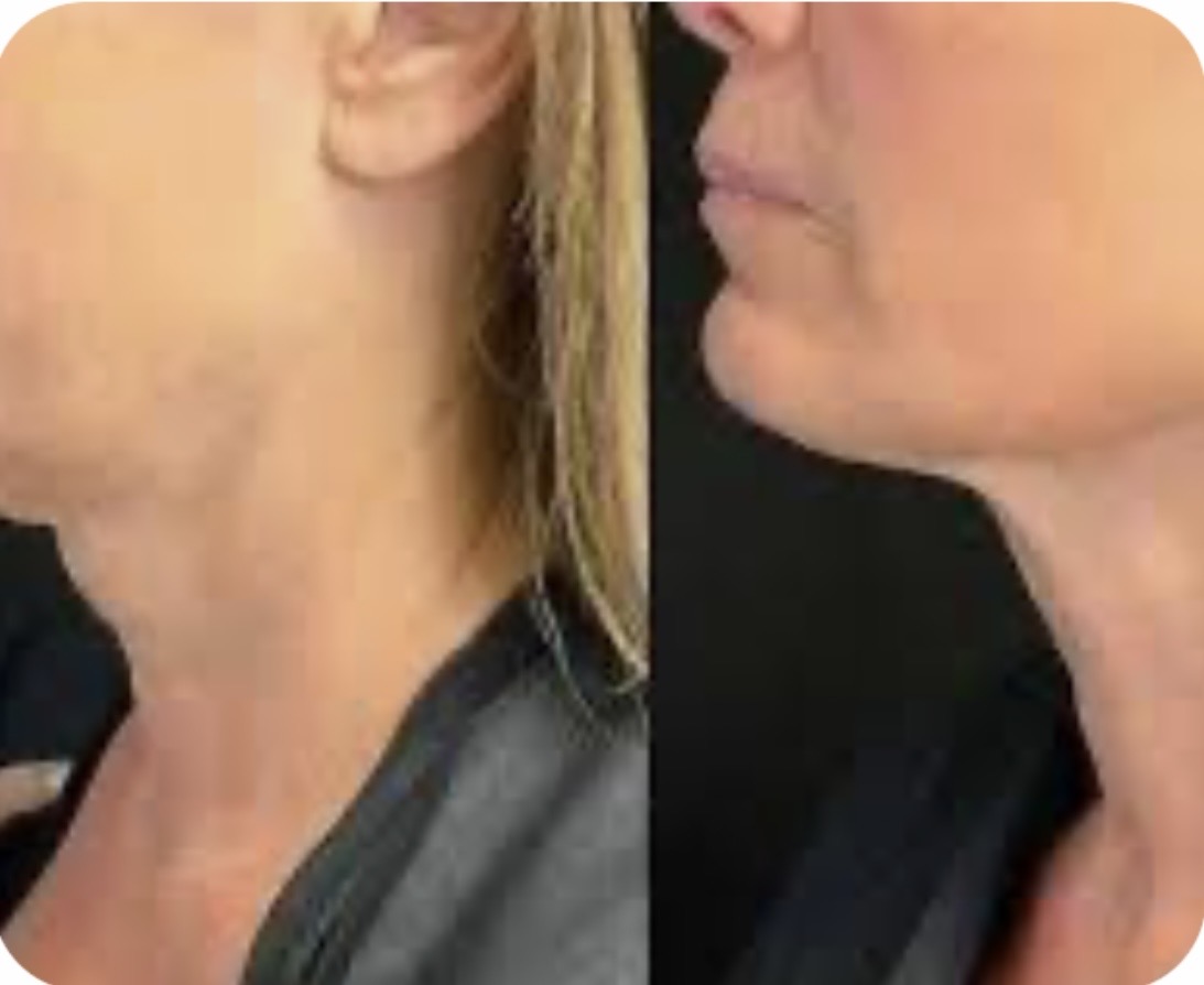 Supplied side-profile before-and-after comparison of the jawline and neck