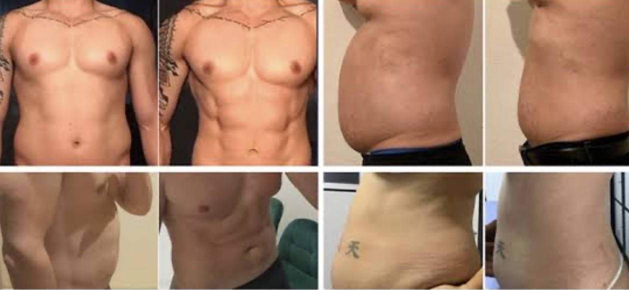 Clinic-supplied before-and-after body contouring examples showing changes in abdominal appearance