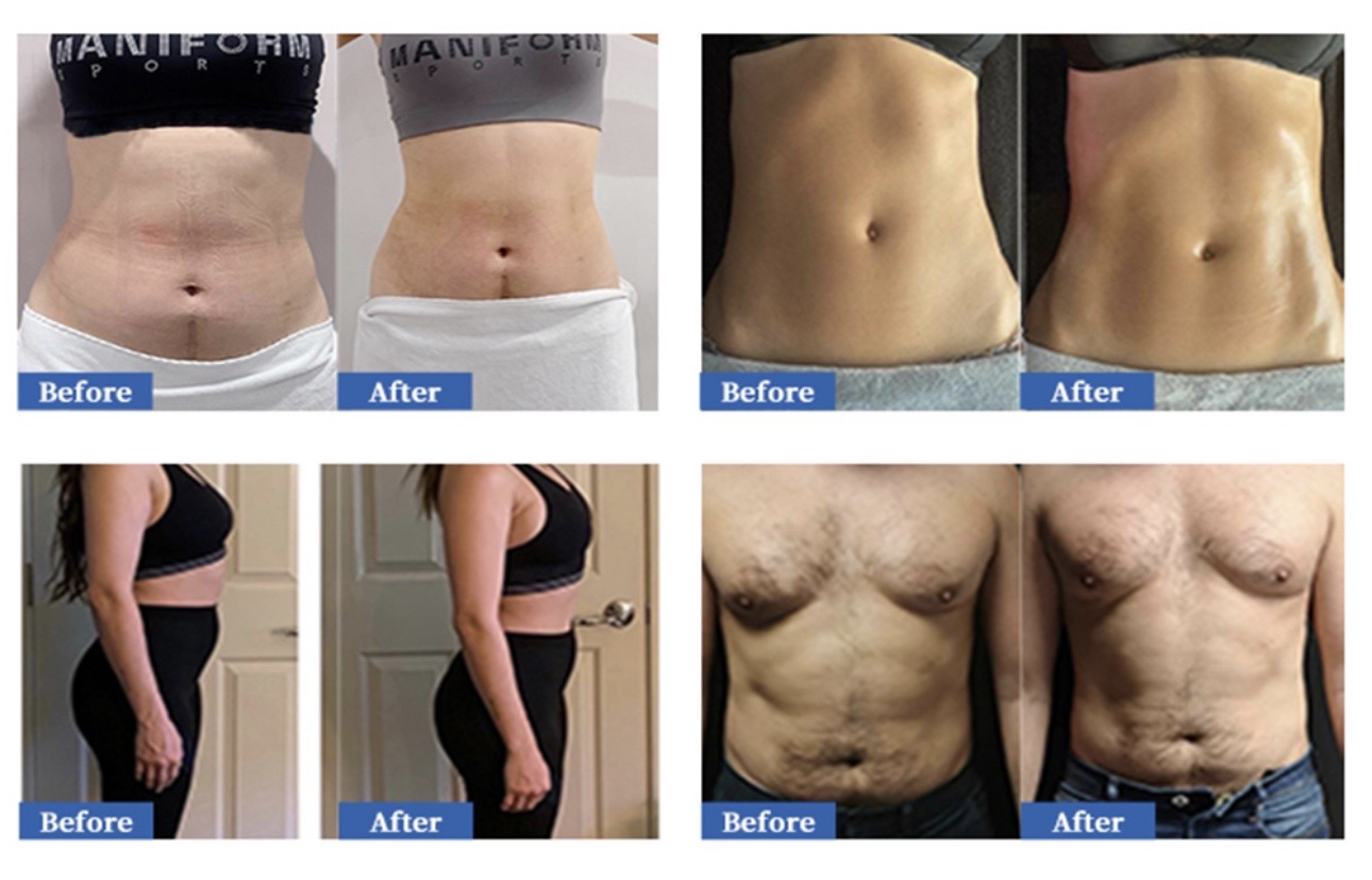 Clinic-supplied before-and-after comparison images for abdomen and side contour