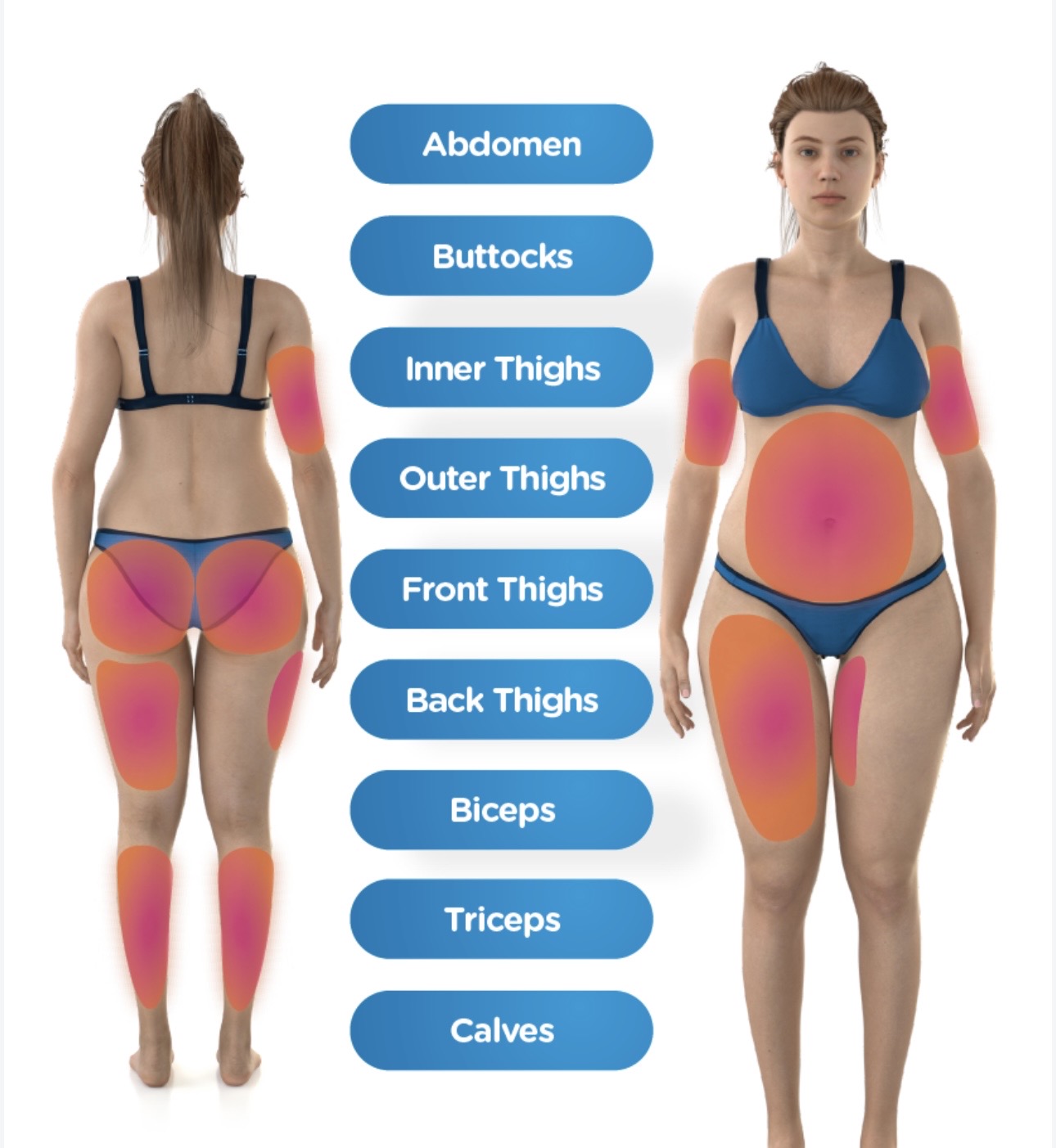 Illustration identifying potential body sculpting areas including abdomen, buttocks, thighs, arms, and calves